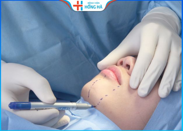 Độn cằm có dễ bị lệch không – 3 điều cần tránh sau khi độn cằm lệch