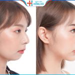 Độn cằm sưng bao lâu? 3 Yếu tố ảnh hưởng tới thời gian phục hồi