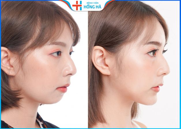 Độn cằm sưng bao lâu? 3 Yếu tố ảnh hưởng tới thời gian phục hồi