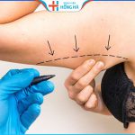 Hút mỡ bắp tay bao lâu hết sưng? Lưu ý chăm sóc giảm sưng đau cấp tốc