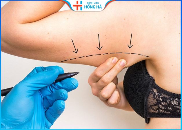 Hút mỡ bắp tay bao lâu hết sưng? Lưu ý chăm sóc giảm sưng đau cấp tốc
