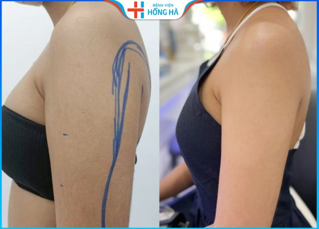 Hút mỡ bắp tay có đau không? Công nghệ hút mỡ không đau