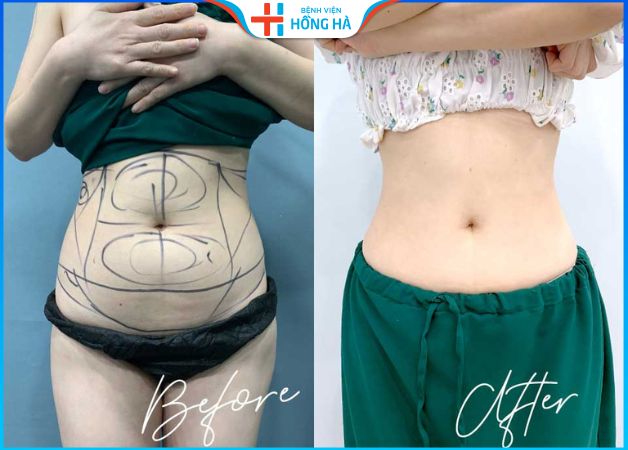 Hút mỡ bụng dưới dưỡng bao lâu? Cách chăm sóc đúng chuẩn