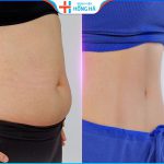 Hút mỡ bụng sau bao lâu thì đẹp? Bí quyết chăm sóc hiệu quả