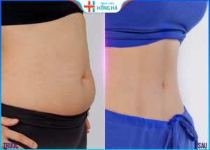 Hút mỡ bụng sau bao lâu thì đẹp? Bí quyết chăm sóc hiệu quả