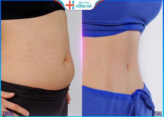 Hút mỡ bụng sau bao lâu thì đẹp? Bí quyết chăm sóc hiệu quả