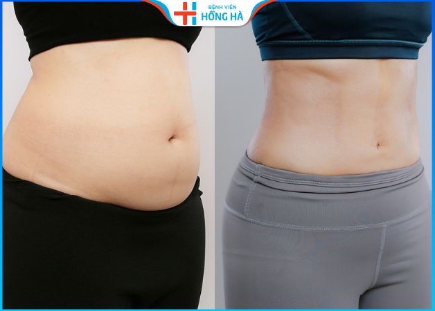 Hút mỡ bụng trên bao lâu thì đẹp – 3 lưu ý sau hút mỡ nhanh lành