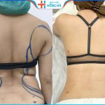 Hút mỡ lưng có nguy hiểm không? Hút mỡ ở đâu hiệu quả tối ưu
