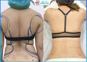 Hút mỡ lưng có nguy hiểm không? Hút mỡ ở đâu hiệu quả tối ưu