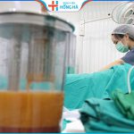 Hút mỡ lưng có tốt không – Công nghệ hút mỡ triệt để 99%