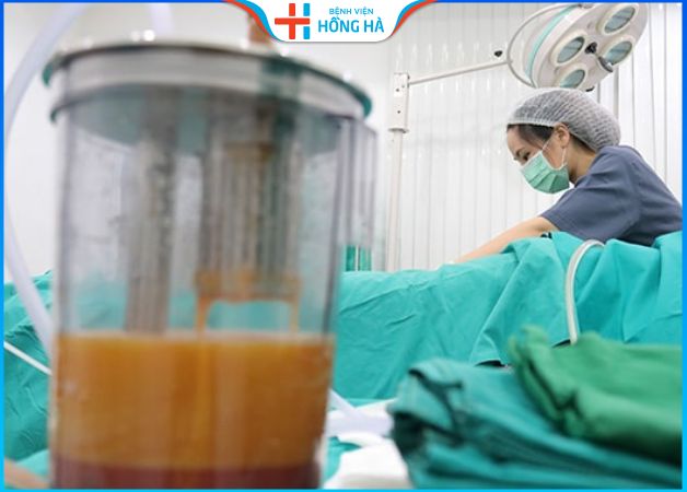 Hút mỡ lưng có tốt không – Công nghệ hút mỡ triệt để 99%