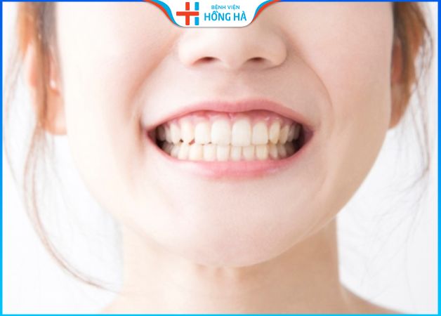 Phương pháp khắc phục cười hở lợi hiệu quả 99% mà bạn chưa biết