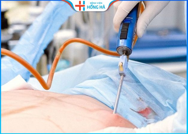 Kinh nghiệm sau hút mỡ bụng từ chuyên gia thẩm mỹ hàng đầu