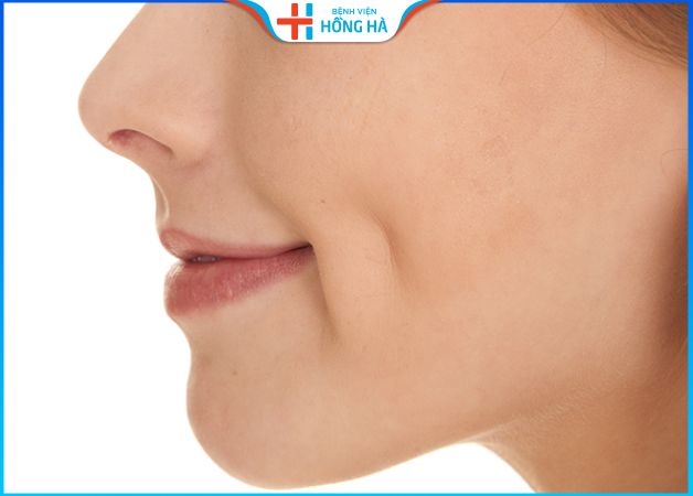 Làm má lúm đồng tiền giữ được bao lâu – Nên kiêng gì ăn gì