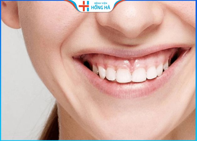 Miệng cười hở lợi: Nguyên nhân, phương pháp khắc phục hiệu quả