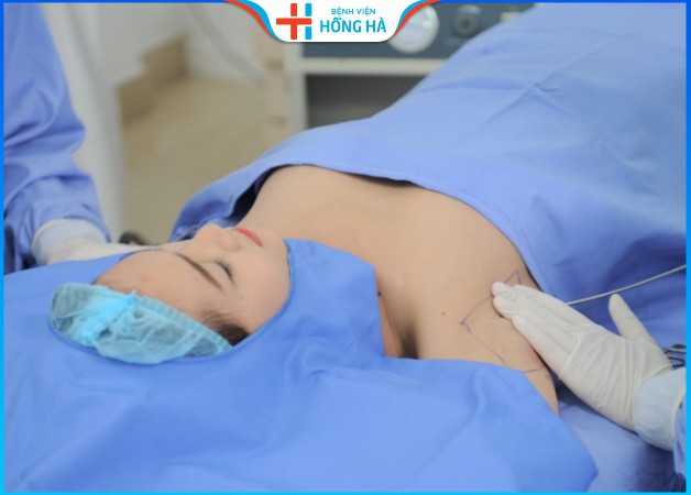 Hút tuyến mồ hôi nách loại bỏ 99% tuyến mồ hôi gây mùi