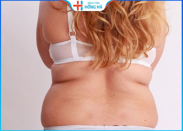 Phẫu thuật hút mỡ lưng: Loại bỏ mỡ thừa, sở hữu tấm lưng ong quyến rũ