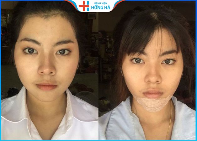 Sau độn cằm bao lâu thì tháo băng –  3 Yếu tố ảnh hưởng phục hồi