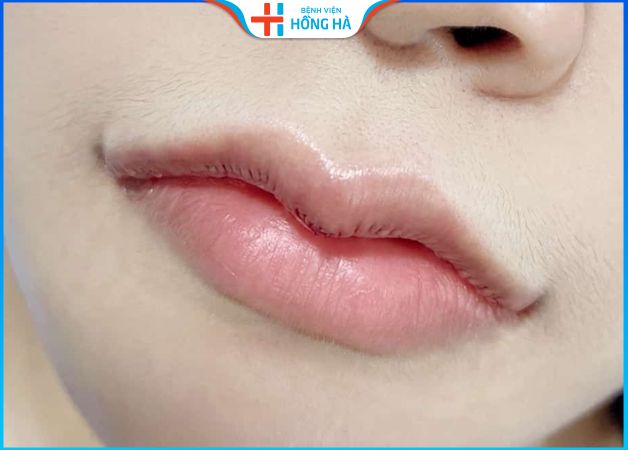 Tạo hình môi trái tim có được vĩnh viễn không? Địa chỉ tạo môi tim đẹp