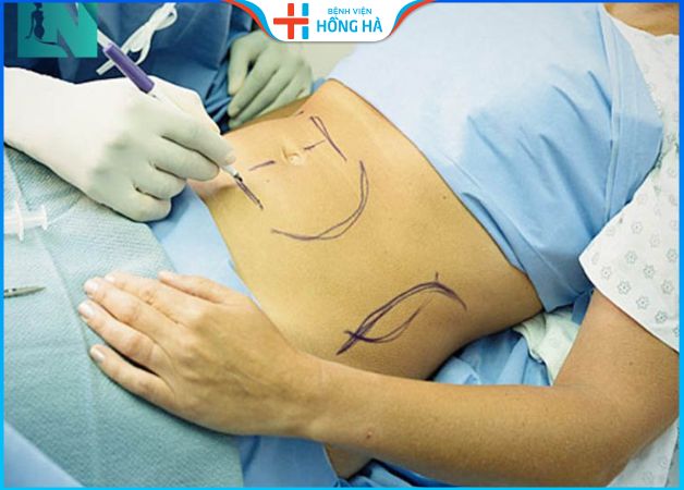 Kinh nghiệm thẩm mỹ hút mỡ bụng nhanh hồi phục, an toàn