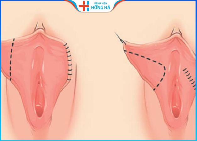 Sau thẩm mỹ chị em dễ dàng đạt khoái cảm khi yêu