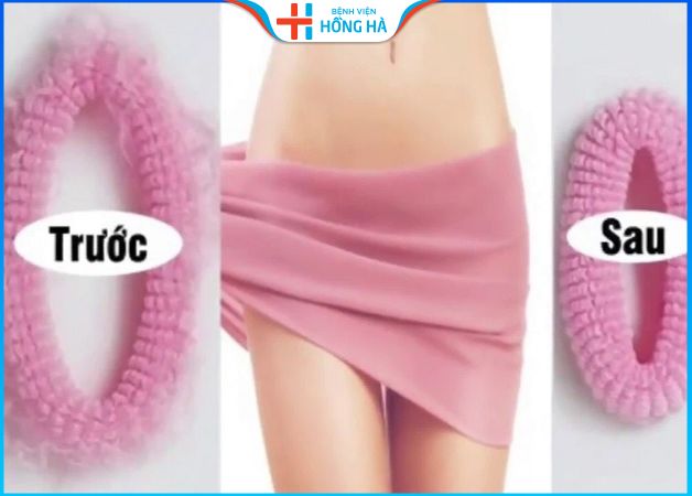 Chị em nên thực hiện thẩm mỹ vùng kín sau sinh