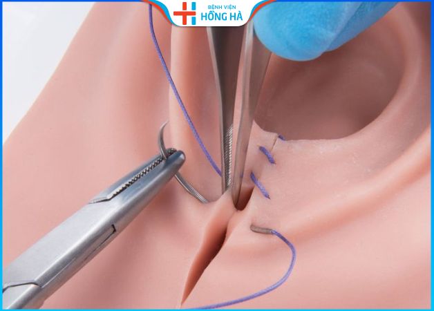 Thực hiện thẩm mỹ vùng kín cho chị em sau sinh đẻ
