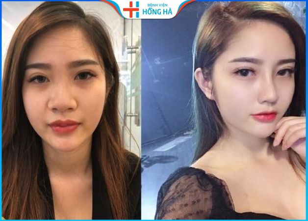 Trước và sau khi thu gọn mũi tại BV Hồng Hà của khách hàng