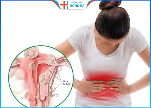 U xơ tử cung và những triệu chứng đau bụng đi kèm