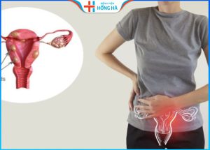U xơ tử cung và việc thụ thai: Tất cả những gì bạn cần biết
