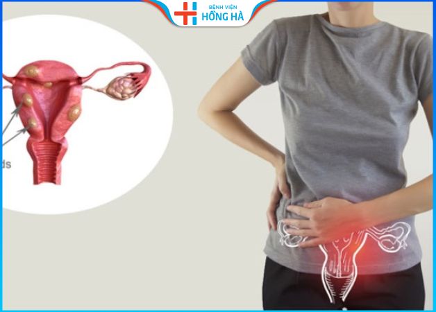 U xơ tử cung và việc thụ thai: Tất cả những gì bạn cần biết