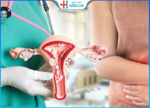 U xơ tử cung và ung thư tử cung: Sự khác nhau và cách phân biệt