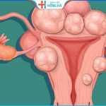 U xơ tử cung dưới thanh mạc:  Nguyên nhân, triệu chứng và điều trị
