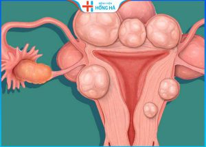 U xơ tử cung dưới thanh mạc:  Nguyên nhân, triệu chứng và điều trị