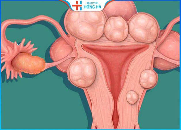 U xơ tử cung dưới thanh mạc:  Nguyên nhân, triệu chứng và điều trị