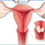 U xơ tử cung dưới thanh mạc khi mang thai – Nguy cơ, ảnh hưởng phải đối mặt