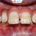 3 Phương pháp chỉnh răng hô hàm trên phổ biến và hiệu quả nhất