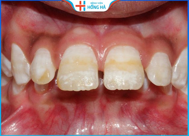 3 Phương pháp chỉnh răng hô hàm trên phổ biến và hiệu quả nhất