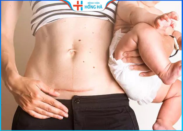 Hút mỡ bụng có sinh em bé được không – Chuyên gia giải đáp