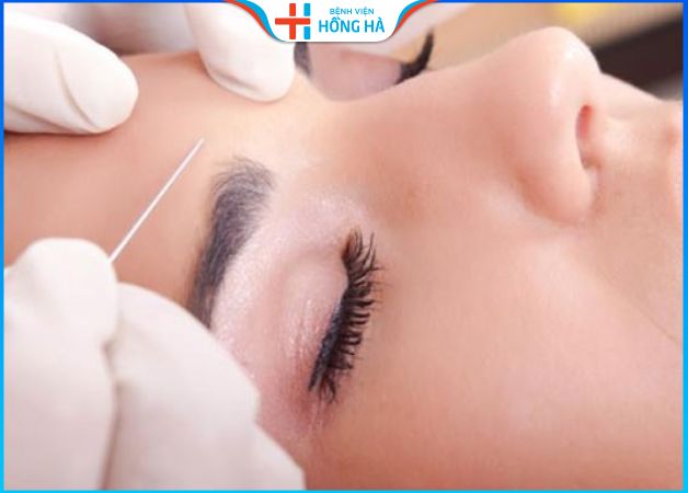 Nâng cung mày không phẫu thuật – Lưu ý chăm sóc sau thẩm mỹ chân mày