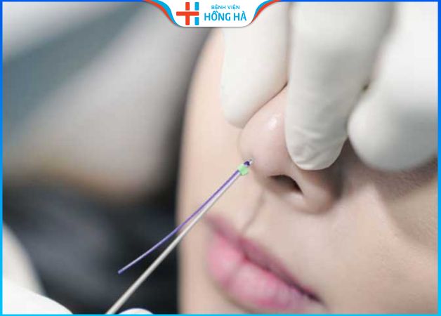 Nâng mũi bằng chỉ có đau không – 4 loại chỉ nâng mũi thông dụng