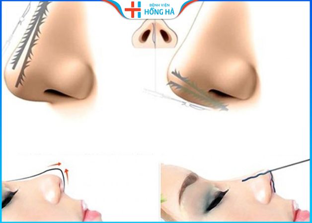Nâng mũi bằng chỉ phù hợp với mũi ít khuyết điểm
