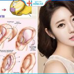 Nâng mũi bằng sụn tai có đau không – Chăm sóc nhanh phục hồi