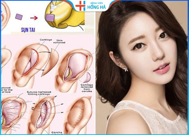 Nâng mũi bằng sụn tai có đau không – Chăm sóc nhanh phục hồi