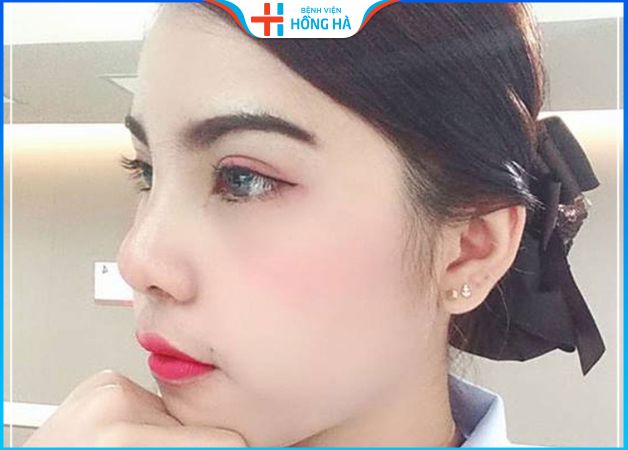 Nâng mũi cấu trúc bao lâu lành – 4 yếu tố ảnh hưởng thời gian phục hồi