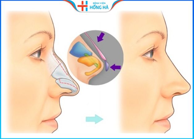 Nâng mũi sụn tự thân giúp nâng cao dáng mũi