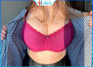 Phẫu thuật thu gọn vú – Giải pháp sở hữu dáng ngực đẹp, hài hòa
