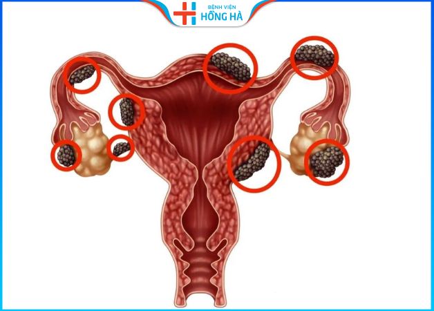 Bệnh lạc nội mạc tử cung là lớp niêm mạc trong tử cung phát triển ra ngoài