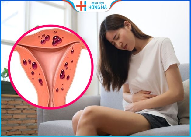 Bệnh lạc nội mạc tử cung: 20% phụ nữ bị ảnh hưởng và những điều cần biết