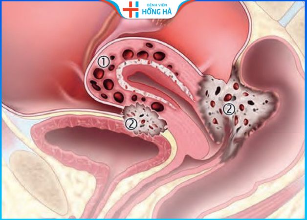 Bệnh lạc nội mạc tử cung: 5% phụ nữ mắc phải và các nguy cơ liên quan